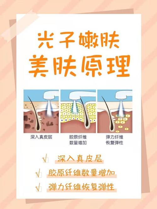 光子嫩肤有哪几种方式