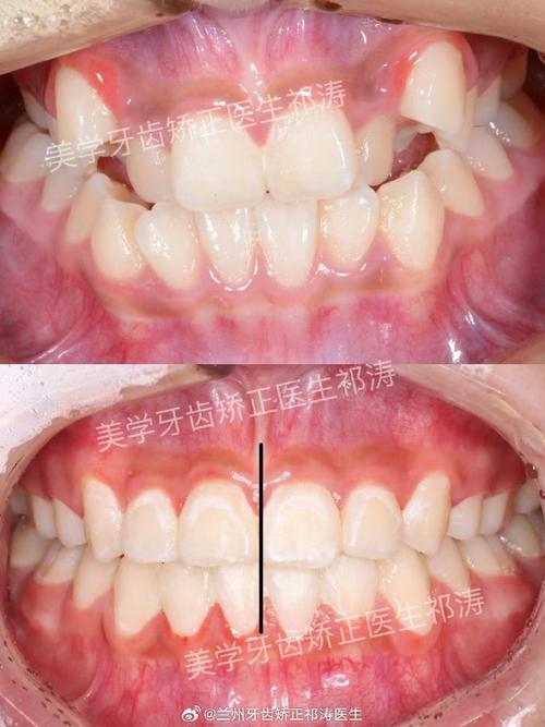 时代天使隐形矫正标准版多少钱?网上一万块的牙套能买吗